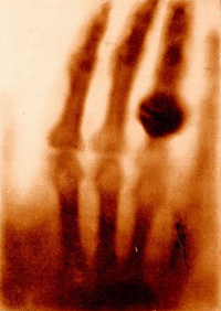 1st x-ray